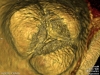 aorta_tcmc.jpg