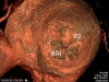 mitral_tcmc_1.jpg