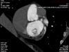 mitral_tcmc_2.jpg